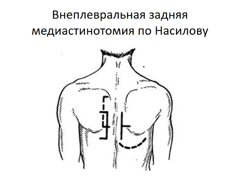 Внеплевральная задняя медиастинотомия по Насилову
